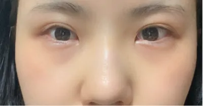 [Mắt] Ppupung - Mắt, Mũi