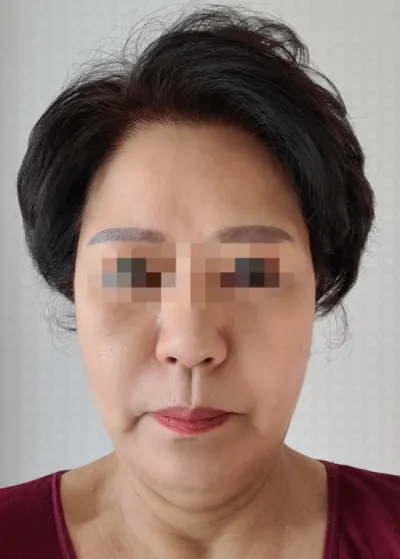 [Chống lão hóa] Acacia - Phẫu thuật căng da mặt