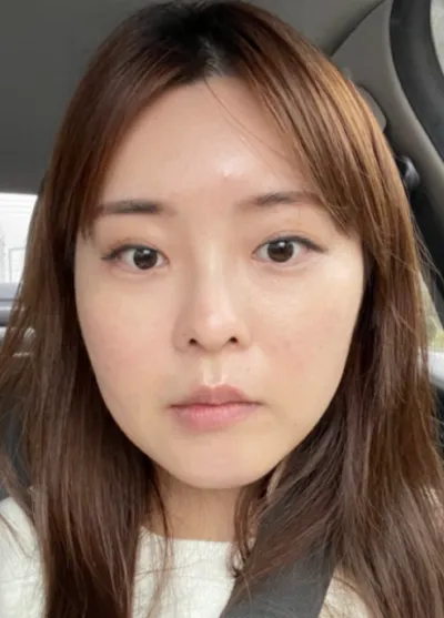 [Gọt mặt] Dr. Moia - Mắt, gọt mặt, mũi, hút mỡ mặt