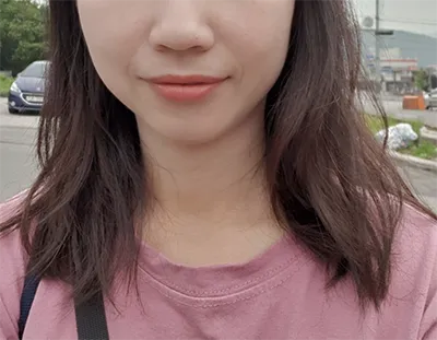 [Tiểu phẫu] Hae 바라기ssi - Shurink, Botox tạo đường nét