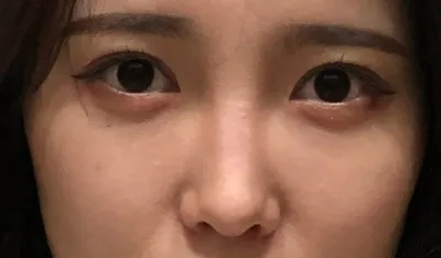 [Mũi] Ánh nắng mặt trời - Mũi