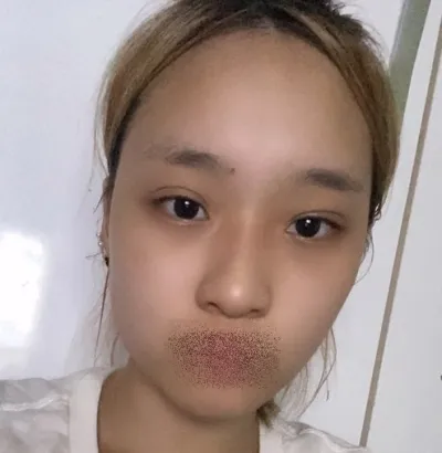 [Gọt mặt] Eclipse - Mắt, mũi, gọt mặt