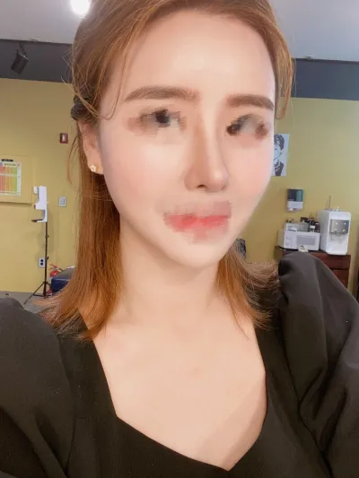 [Chống lão hóa] Hỏi đáp - Cấy mỡ toàn mặt, mũi