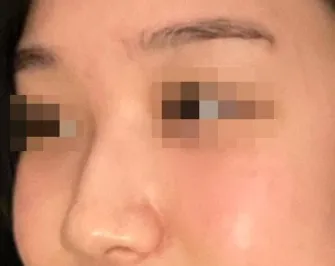 [Mũi] Cẩn thận cảm lạnh - Mũi