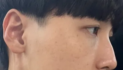 [Gọt mặt] Được hai tháng rồi - Mắt, mũi, đường nét khuôn mặt