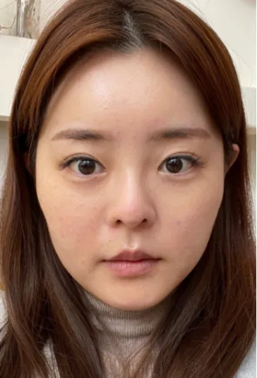 [Mũi] Mingamingeo - Mắt, Mũi, Hút Mỡ Mặt