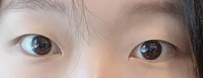 [Mắt] Mắt một mí thành hai mí tự nhiên