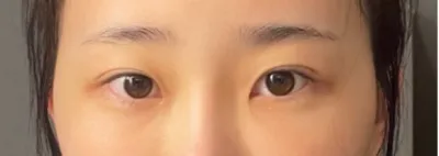 [Mắt] Nghe đồn - Mắt