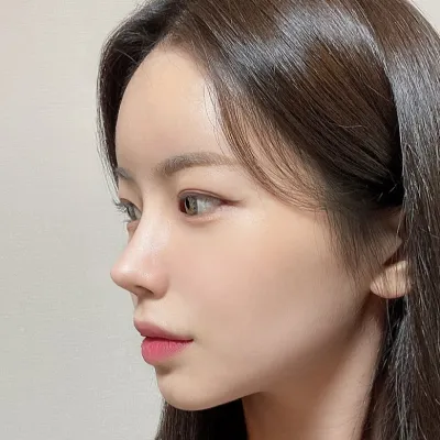 [Mũi] Dior - Đầu mũi, sống mũi, gọt xương, mũi gồ, mũi vẹo