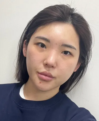 [Mắt] Đào - Chỉnh sửa mí mắt không phẫu thuật (Tái phẫu thuật), Mở góc mắt trên, Mở góc mắt dưới