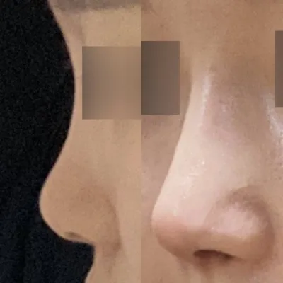 Mình đã phẫu thuật mũi lần đầu tại Weavers