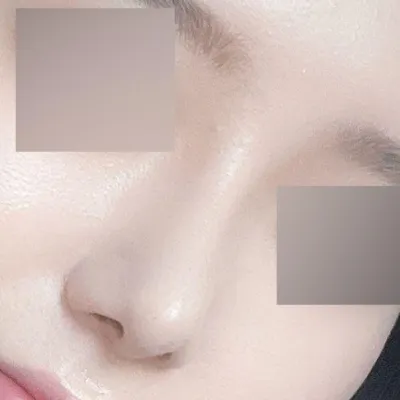 Đã được 1 tháng kể từ khi phẫu thuật