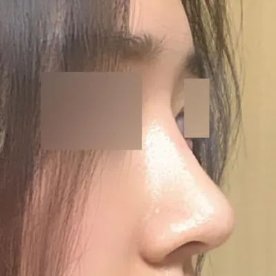 Mình đã sửa mũi lệch và mũi to