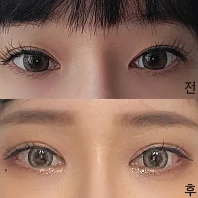 Đã được khoảng hai tháng kể từ khi mình phẫu thuật lại mắt ㅎ