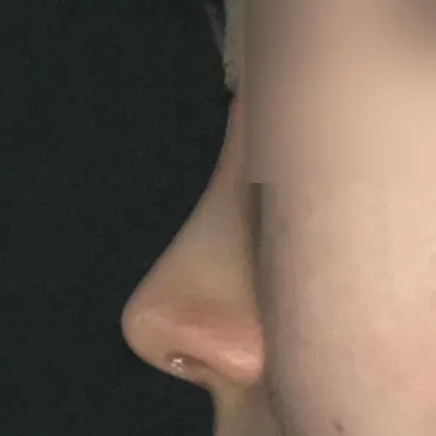 Mình đã phẫu thuật mũi với bác sĩ Seo Seung-jo được 1 tháng rồi!