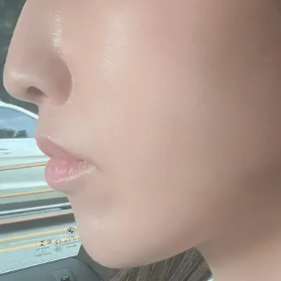 Mình đã cải thiện nếp nhăn rãnh cười mà mình lo lắng!