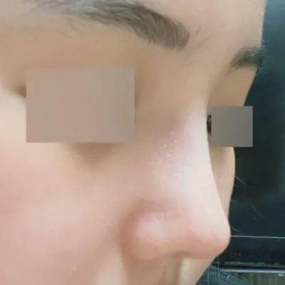 Đã 2 tháng kể từ khi phẫu thuật mũi ngắn + mũi chức năng