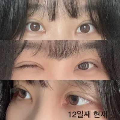 Bài đánh giá chân thực về sự hài lòng thực sự sau khi phẫu thuật mắt hai mí lại