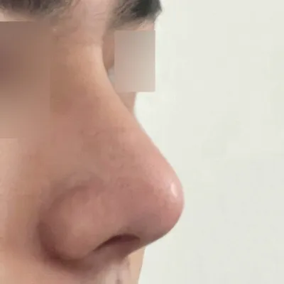 Mình đã phẫu thuật với bác sĩ Shim Jung-hwan được 1 tháng rồi.