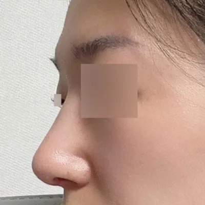 Mình đã phẫu thuật gồ sống mũi không dùng chất liệu độn!