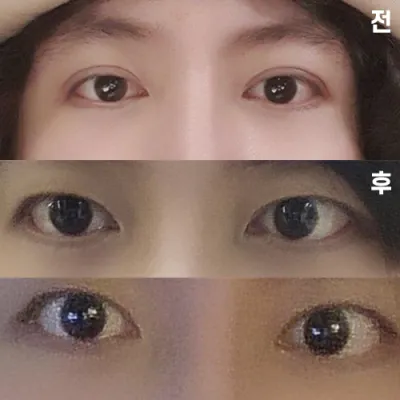 Tình trạng sau hạ đường viền mí đôi