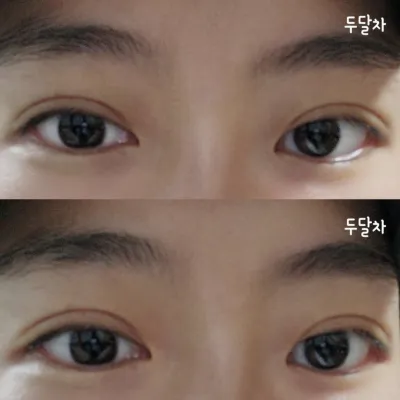 Đánh giá thật sau 2 tháng phẫu thuật mắt ~^^