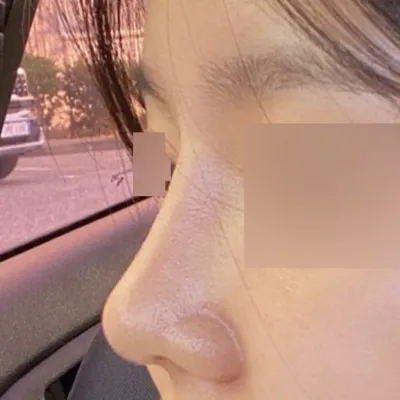 Đã 3 tháng kể từ khi mình phẫu thuật nâng mũi tẹt