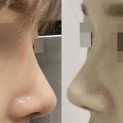 Đã 3 tháng kể từ khi mình phẫu thuật mũi