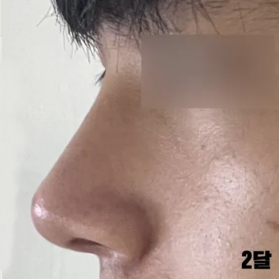 Mình đã thu nhỏ cánh mũi khi phẫu thuật và mình hài lòng.