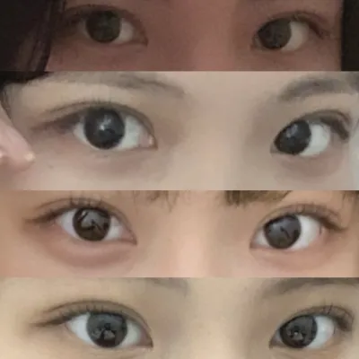 (Khâu dính tự nhiên, chỉnh hình mắt, mở góc mắt trong) Đã phẫu thuật được 4 tháng