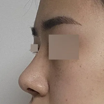 Mình đã phẫu thuật được 3 tháng rồi.