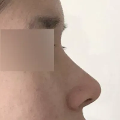 Review sau 3 tháng phẫu thuật mũi!