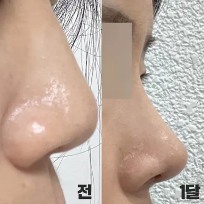 Một tháng sau phẫu thuật nâng mũi dáng thẳng