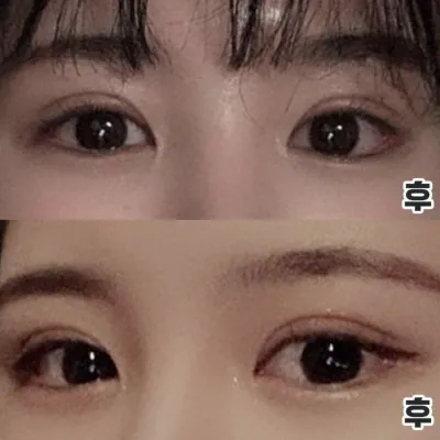 Mắt mình dài ra theo chiều ngang! Thành công sau phẫu thuật lại