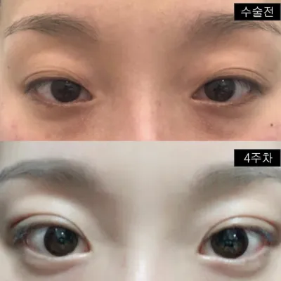 Mình đã giải quyết được nỗi lo về mí mắt sụp và nếp nhăn đôi