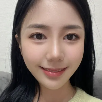 Đã 3 tháng kể từ khi phẫu thuật nâng mũi và tái phẫu thuật mắt