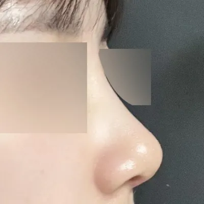 Chiếc mũi từng là mặc cảm của mình đã trở nên xinh đẹp!