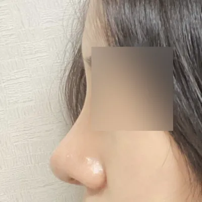 Mình tin tưởng và làm ở chỗ bạn mình đã phẫu thuật ㅎㅎ