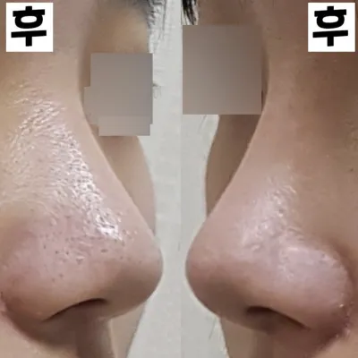 Đã 2 tuần kể từ ca phẫu thuật mũi đầu tiên của mình!