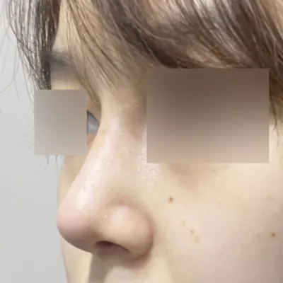 Review sau một tháng sau khi phẫu thuật lại mũi tại Bệnh viện thẩm mỹ Weavers~! 