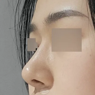 Đã 5 tháng kể từ khi mình phẫu thuật tại Weverse