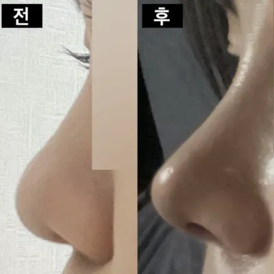 Đã được 1 tháng kể từ khi phẫu thuật mũi rồi đó ㅎ