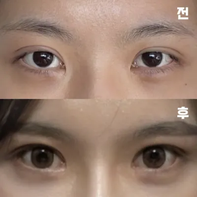 Mình đã mong chờ diện mạo sau khi hết sưng từ bây giờ