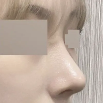 Đã phẫu thuật được 2 tháng rồi đó ạ!!