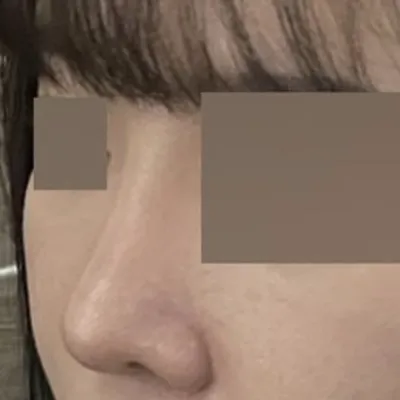 Đã 4 tháng kể từ khi phẫu thuật!! ㅎㅎ