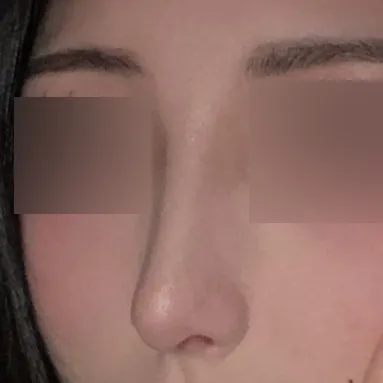 Mình đã quyết định phẫu thuật vì quá căng thẳng với chiếc mũi khoằm!!