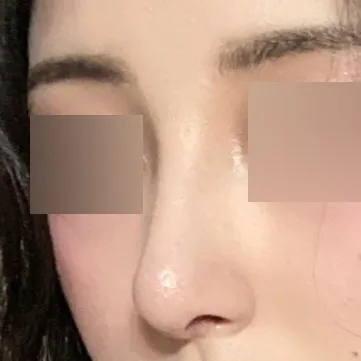 Đã được một tháng kể từ khi phẫu thuật.