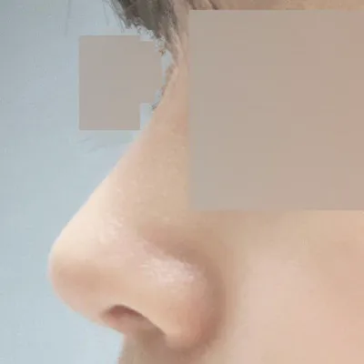 Đã được 2 tháng kể từ khi mình phẫu thuật mũi tại Bệnh viện thẩm mỹ Weavers