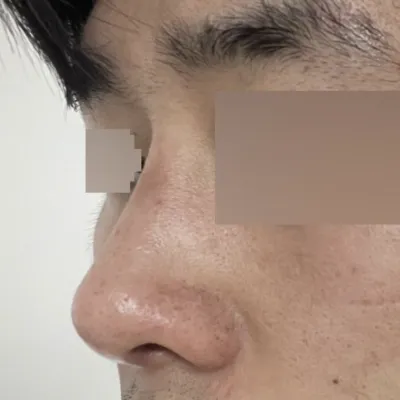 Mình hy vọng vết sưng sẽ giảm bớt và trông tự nhiên hơn