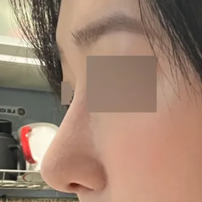 Mình đã lo lắng về việc phẫu thuật mũi lần đầu ở nhiều nơi và cuối cùng đã phẫu thuật mũi.